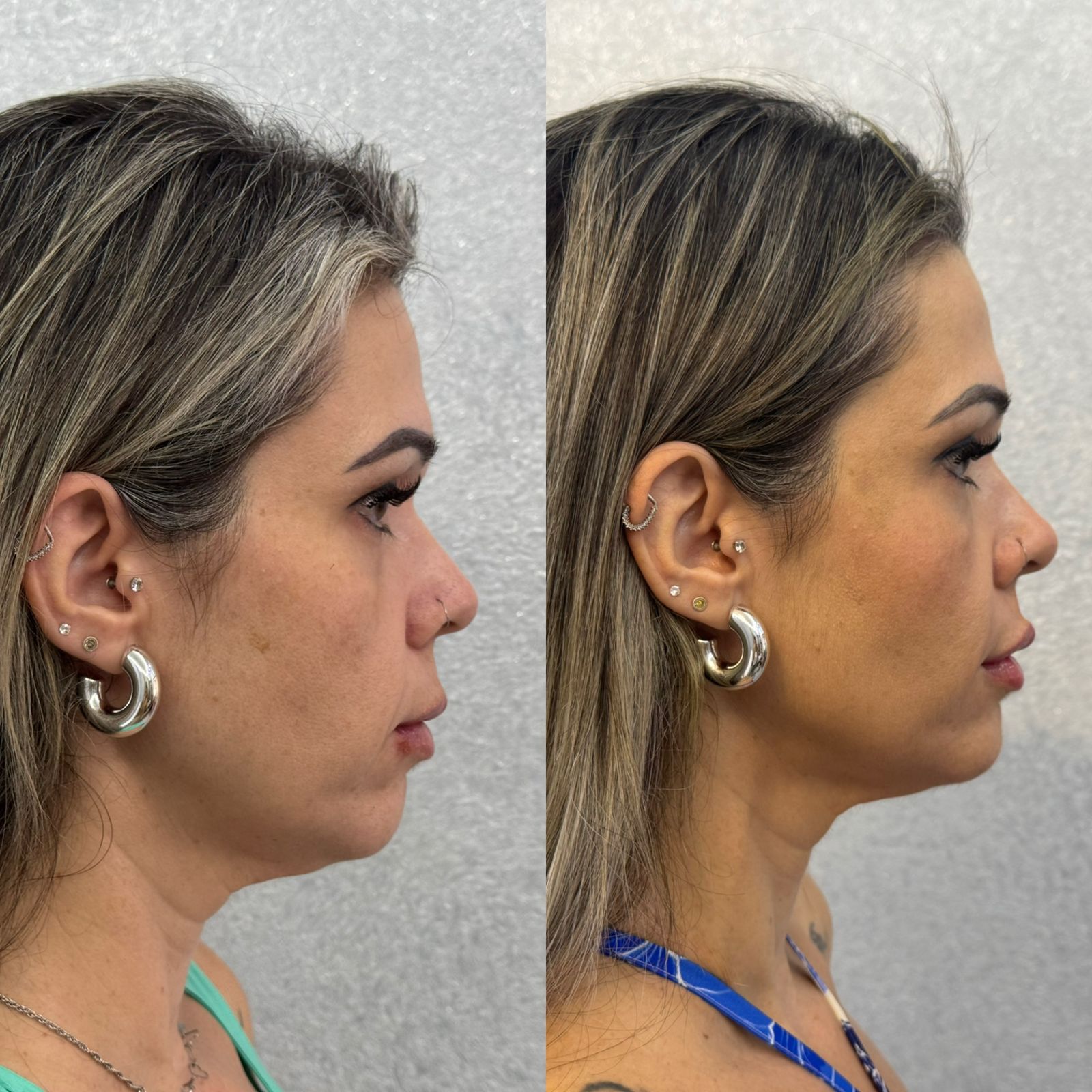 Resultado Antes e Depois